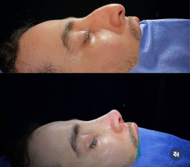 trapianto di capelli